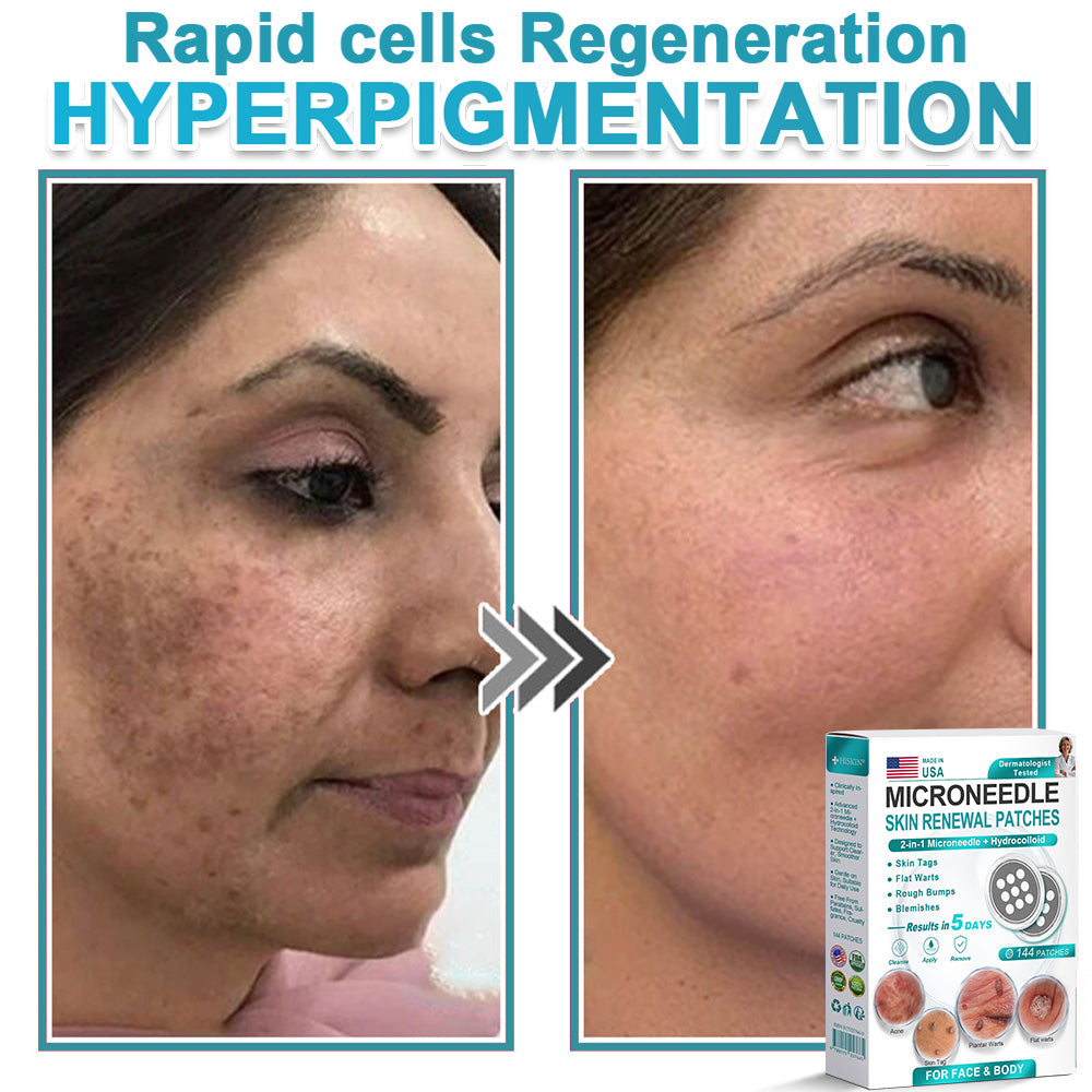 Virexo™ 2-in-1 Microneedle & Hydrocolloid Patch👨‍⚕️ | Removes raised moles, acne, flat warts, and skin tags | Helps improve wrinkles, scars, and blemishes | Invisible patches for face and body💖