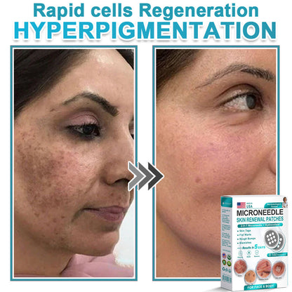 Virexo™ 2-in-1 Microneedle & Hydrocolloid Patch👨‍⚕️ | Removes raised moles, acne, flat warts, and skin tags | Helps improve wrinkles, scars, and blemishes | Invisible patches for face and body💖