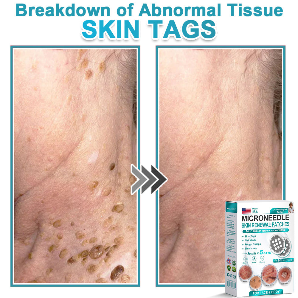 Virexo™ 2-in-1 Microneedle & Hydrocolloid Patch👨‍⚕️ | Removes raised moles, acne, flat warts, and skin tags | Helps improve wrinkles, scars, and blemishes | Invisible patches for face and body💖