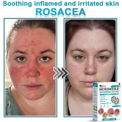Virexo™ 2-in-1 Microneedle & Hydrocolloid Patch👨‍⚕️ | Removes raised moles, acne, flat warts, and skin tags | Helps improve wrinkles, scars, and blemishes | Invisible patches for face and body💖