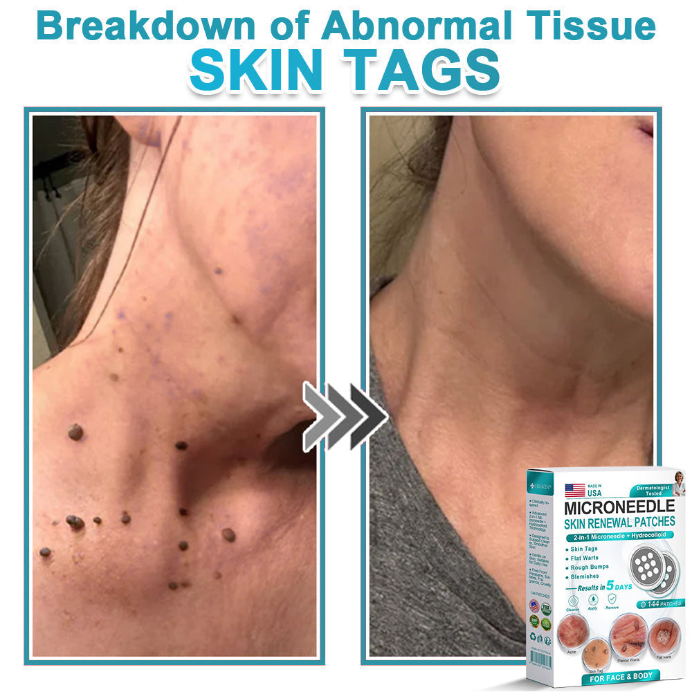 Virexo™ 2-in-1 Microneedle & Hydrocolloid Patch👨‍⚕️ | Removes raised moles, acne, flat warts, and skin tags | Helps improve wrinkles, scars, and blemishes | Invisible patches for face and body💖