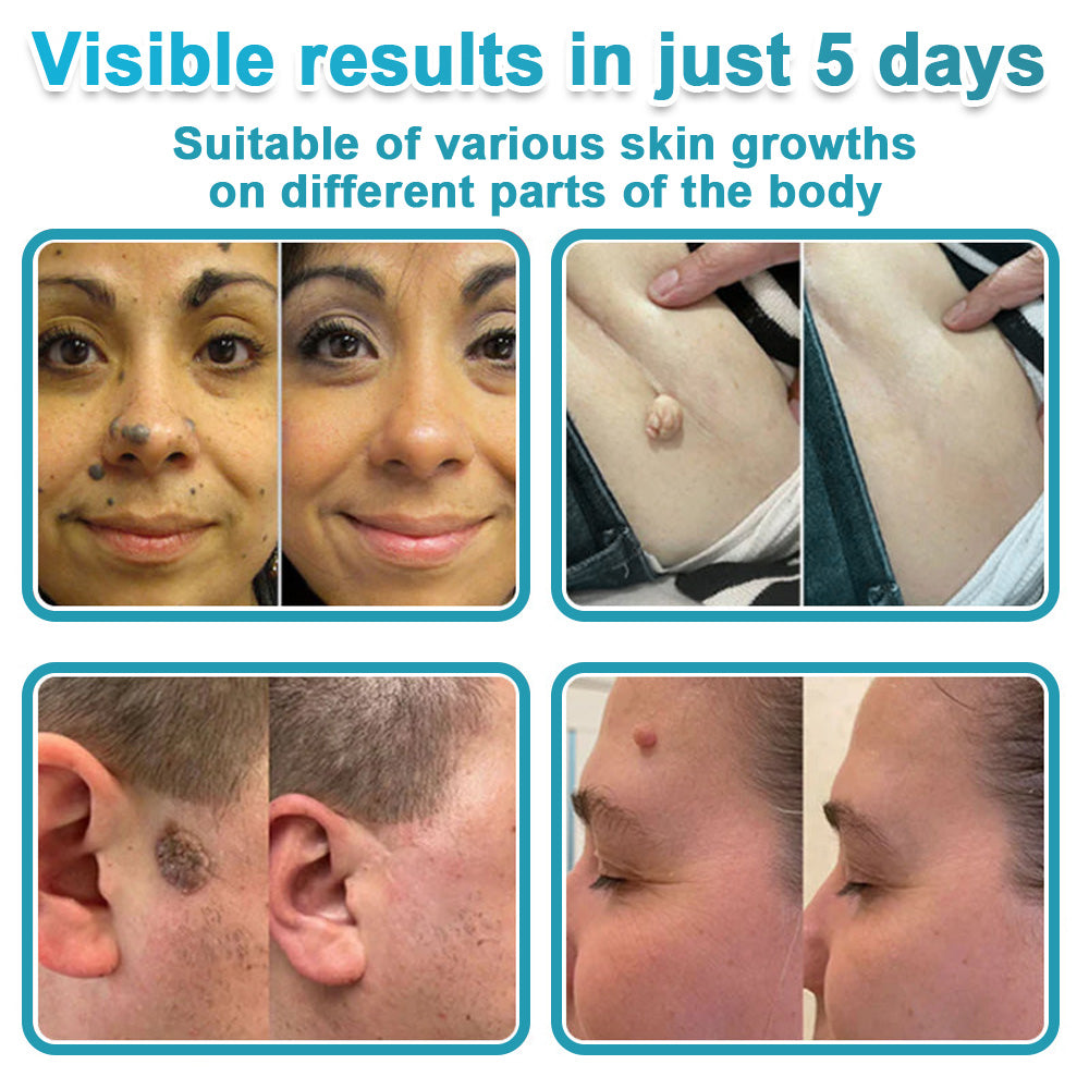 Virexo™ 2-in-1 Microneedle & Hydrocolloid Patch👨‍⚕️ | Removes raised moles, acne, flat warts, and skin tags | Helps improve wrinkles, scars, and blemishes | Invisible patches for face and body💖