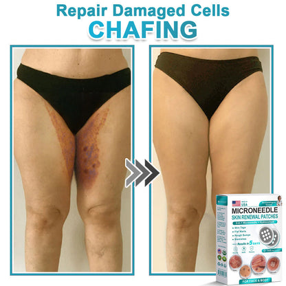 Virexo™ 2-in-1 Microneedle & Hydrocolloid Patch👨‍⚕️ | Removes raised moles, acne, flat warts, and skin tags | Helps improve wrinkles, scars, and blemishes | Invisible patches for face and body💖