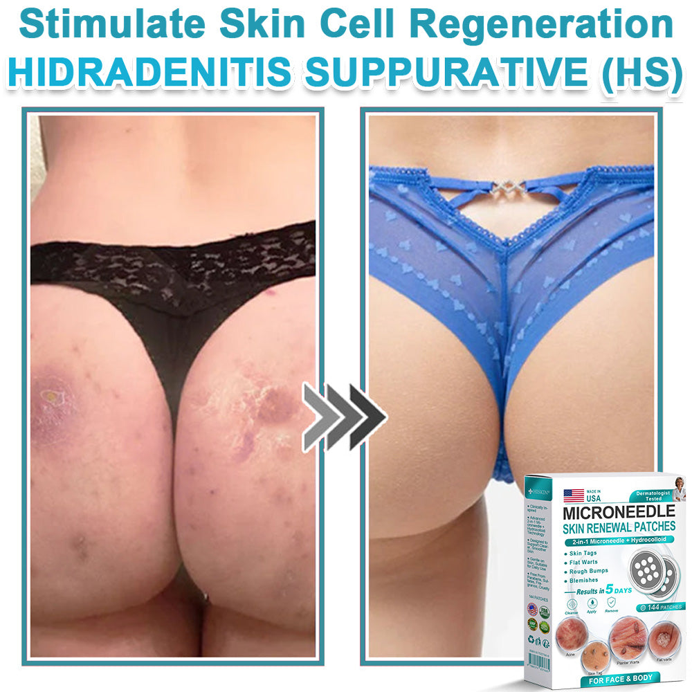 Virexo™ 2-in-1 Microneedle & Hydrocolloid Patch👨‍⚕️ | Removes raised moles, acne, flat warts, and skin tags | Helps improve wrinkles, scars, and blemishes | Invisible patches for face and body💖