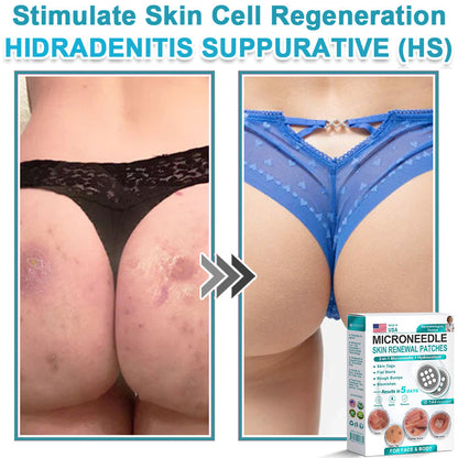 Virexo™ 2-in-1 Microneedle & Hydrocolloid Patch👨‍⚕️ | Removes raised moles, acne, flat warts, and skin tags | Helps improve wrinkles, scars, and blemishes | Invisible patches for face and body💖