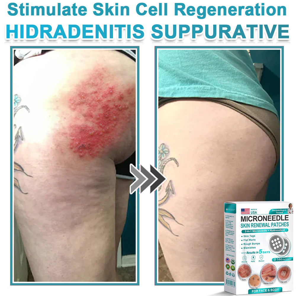 Virexo™ 2-in-1 Microneedle & Hydrocolloid Patch👨‍⚕️ | Removes raised moles, acne, flat warts, and skin tags | Helps improve wrinkles, scars, and blemishes | Invisible patches for face and body💖