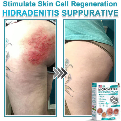 Virexo™ 2-in-1 Microneedle & Hydrocolloid Patch👨‍⚕️ | Removes raised moles, acne, flat warts, and skin tags | Helps improve wrinkles, scars, and blemishes | Invisible patches for face and body💖
