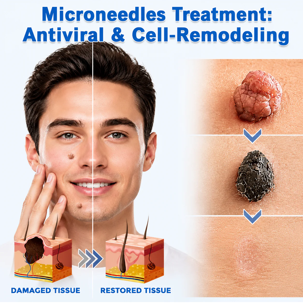 Virexo™ 2-in-1 Microneedle & Hydrocolloid Patch👨‍⚕️ | Removes raised moles, acne, flat warts, and skin tags | Helps improve wrinkles, scars, and blemishes | Invisible patches for face and body💖
