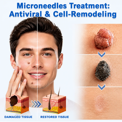 Virexo™ 2-in-1 Microneedle & Hydrocolloid Patch👨‍⚕️ | Removes raised moles, acne, flat warts, and skin tags | Helps improve wrinkles, scars, and blemishes | Invisible patches for face and body💖