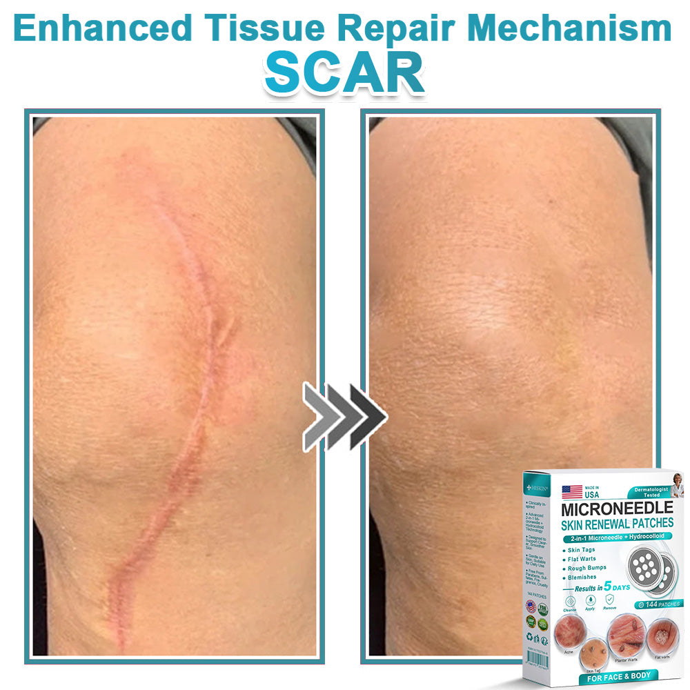 Virexo™ 2-in-1 Microneedle & Hydrocolloid Patch👨‍⚕️ | Removes raised moles, acne, flat warts, and skin tags | Helps improve wrinkles, scars, and blemishes | Invisible patches for face and body💖