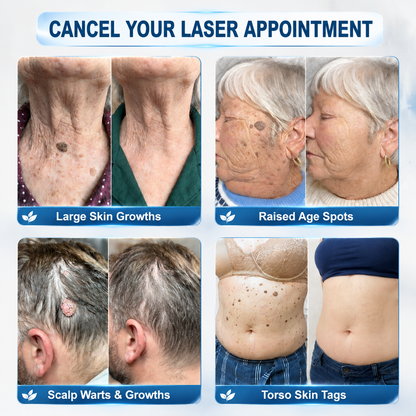 FDA Registered Facility|𝟕-𝐃𝒂𝘆 𝐒𝗸𝐢𝐧 𝐓𝒂𝗴 & 𝐒𝐩𝙤𝐭 𝐄𝐫𝒂𝐬𝙚𝐫 Painless & Scar-Free Advanced Imperfection Removal Rollerball Pen